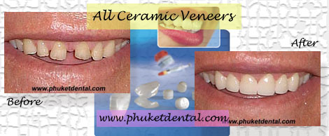 dental veneers